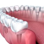 The Benefits of Choosing Dental Implants in Melbourne for Missing Teeth