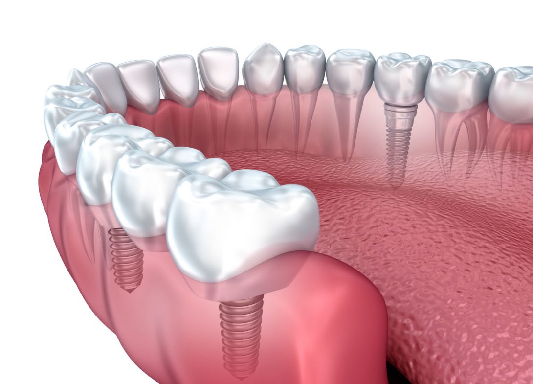 The Benefits of Choosing Dental Implants in Melbourne for Missing Teeth