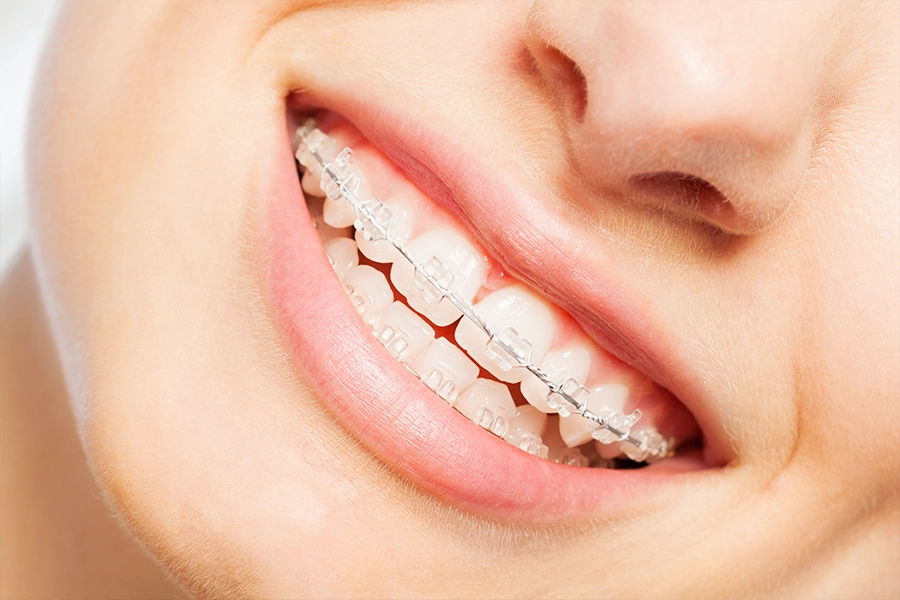 The Benefits of Invisible Braces in Clapham